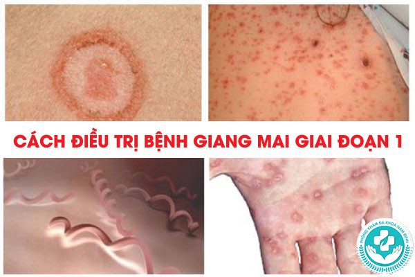 giang mai giai đoạn 1
