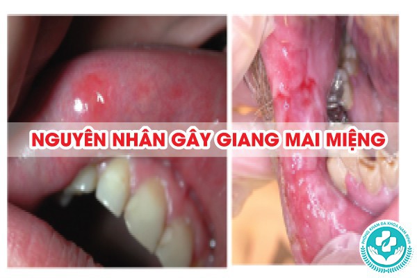 giang mai ở miệng giai đoạn đầu