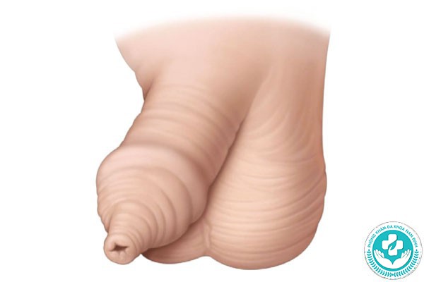 hình ảnh bao quy đầu dài hình ảnh bao quy đầu dài