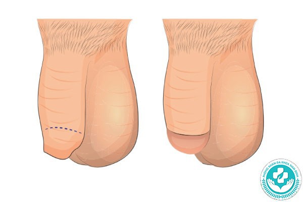 hình ảnh bao quy đầu dài hình ảnh bao quy đầu dài