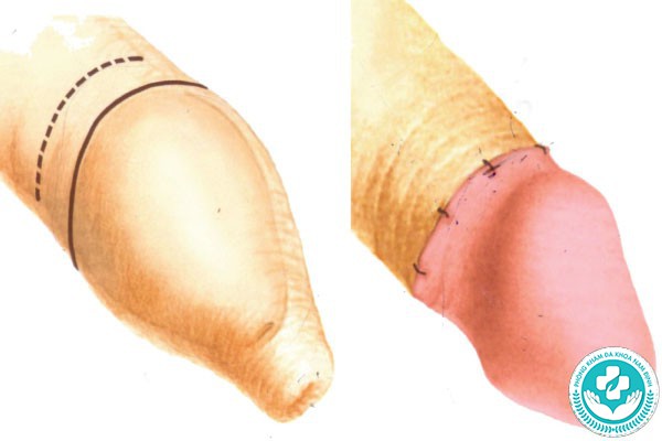 hình ảnh bao quy đầu dài hình ảnh bao quy đầu dài