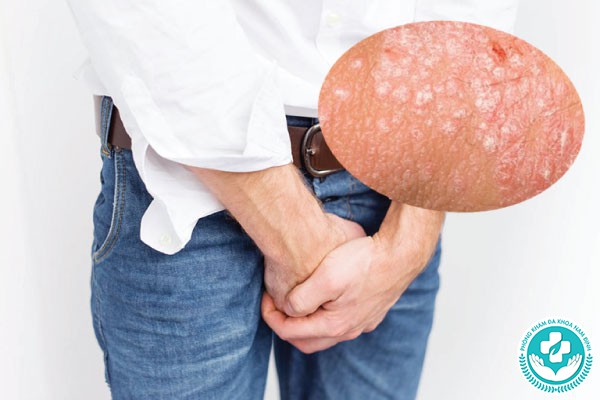Hình ảnh bệnh chàm bìu Hình ảnh bệnh chàm bìu