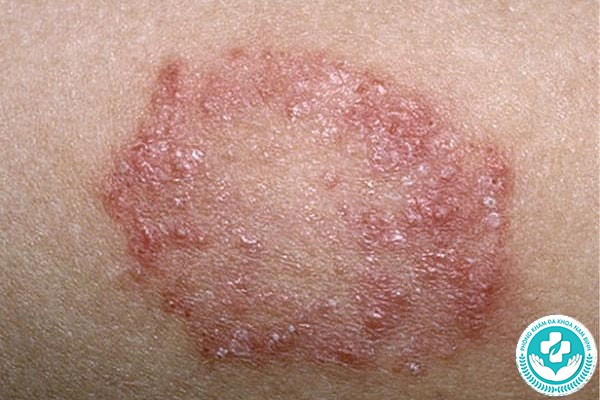 Hình ảnh bệnh chàm bìu Hình ảnh bệnh chàm bìu