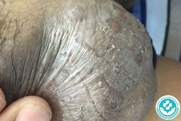 Hình ảnh bệnh chàm bìu Hình ảnh bệnh chàm bìu
