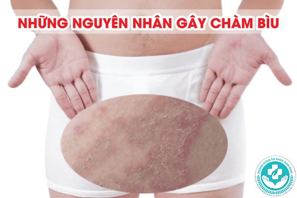 Hình ảnh bệnh chàm bìu Hình ảnh bệnh chàm bìu