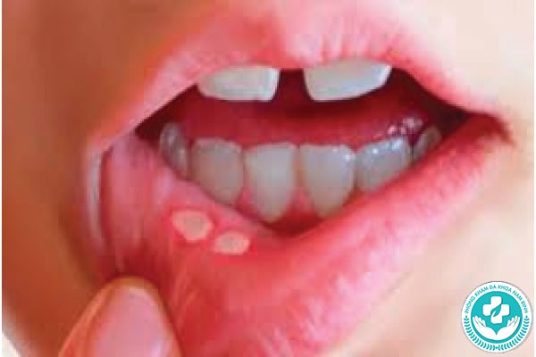 hình ảnh bệnh giang mai ở miệng