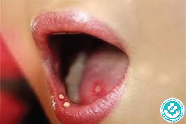 hình ảnh bệnh giang mai ở miệng