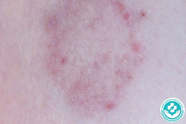 Hình ảnh bệnh nấm bìu