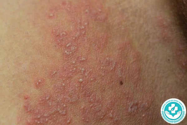 Hình ảnh bệnh nấm bìu