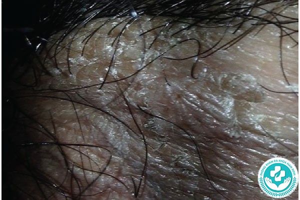 Hình ảnh bệnh nấm bìu