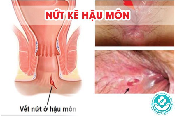 hình ảnh bệnh nứt kẽ hậu môn