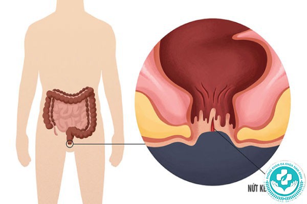 hình ảnh bệnh nứt kẽ hậu môn