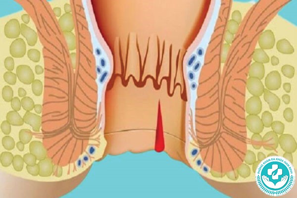 hình ảnh bệnh nứt kẽ hậu môn