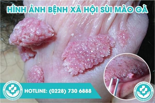 hình ảnh bệnh xã hội