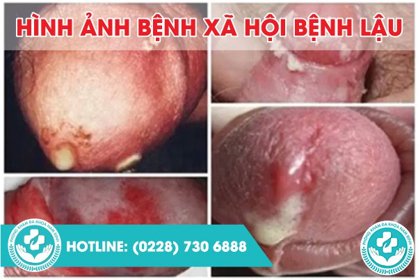 hình ảnh bệnh xã hội