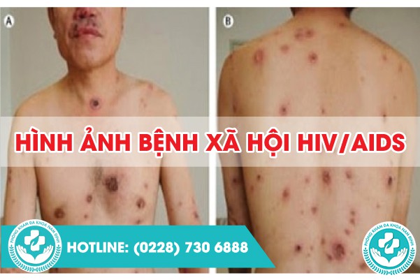 hình ảnh bệnh xã hội