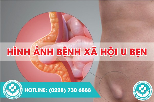 hình ảnh bệnh xã hội