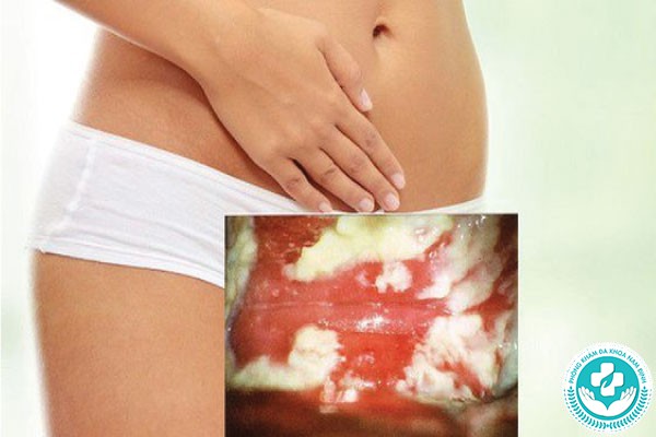 hình ảnh bị nấm vùng kín
