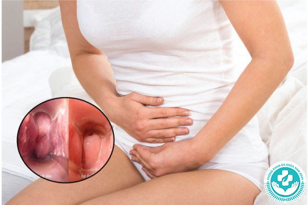 hình ảnh bị nấm vùng kín