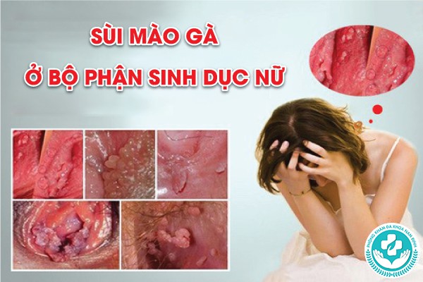 hình ảnh bị sùi mào gà