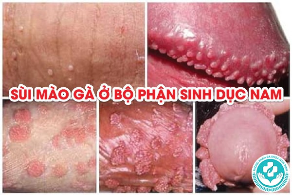 hình ảnh bị sùi mào gà