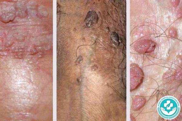 hình ảnh các bệnh lây truyền qua đường tình dục