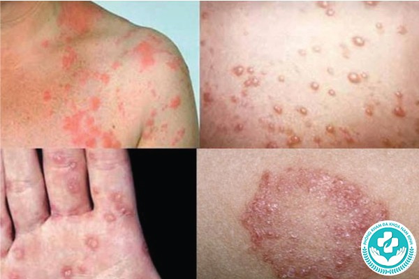 hình ảnh các bệnh lây truyền qua đường tình dục