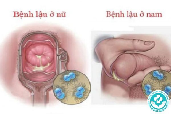 hình ảnh các bệnh lây truyền qua đường tình dục