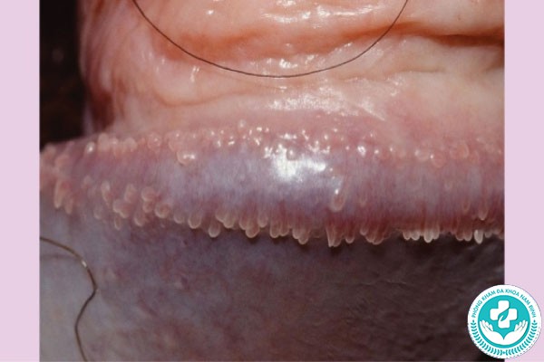 hình ảnh chuỗi hạt ngọc dương vật