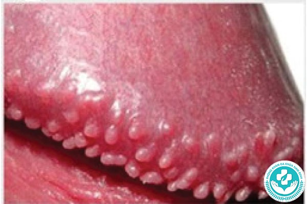 hình ảnh chuỗi hạt ngọc dương vật