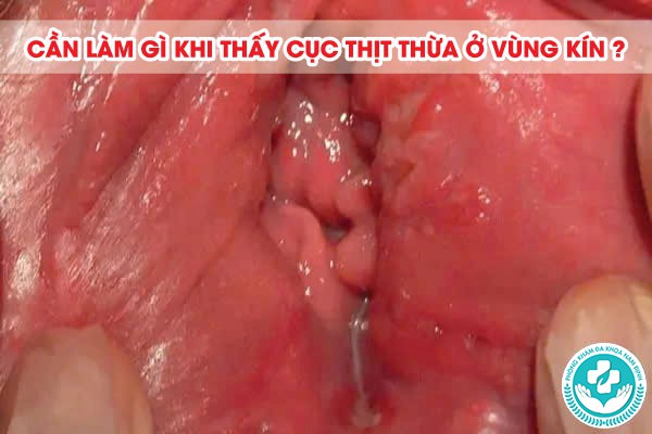 hình ảnh cục thịt thừa ở vùng kín