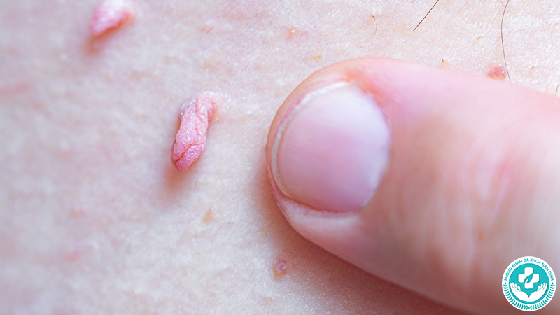 hình ảnh cục thịt thừa ở vùng kín