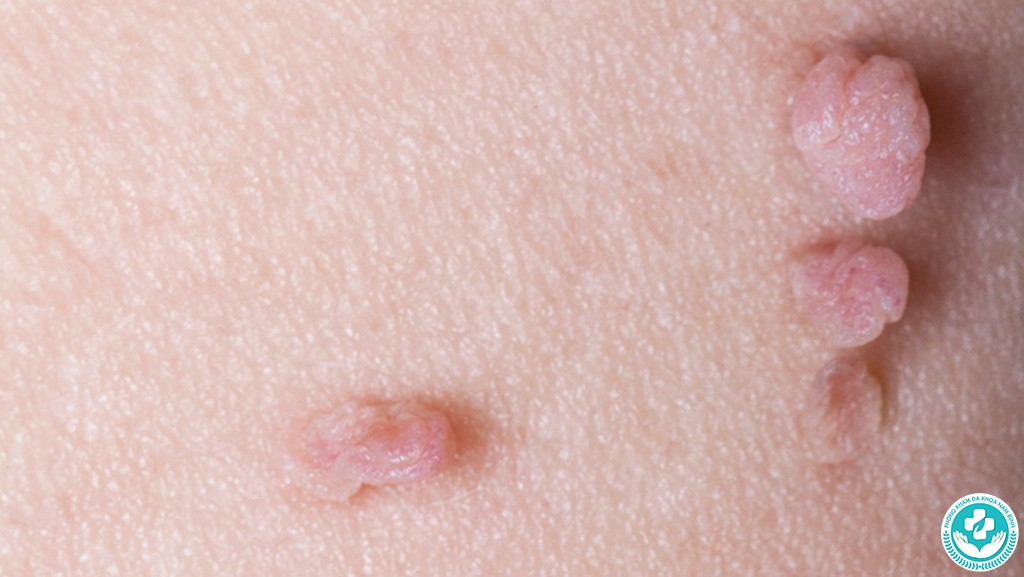 hình ảnh cục thịt thừa ở vùng kín