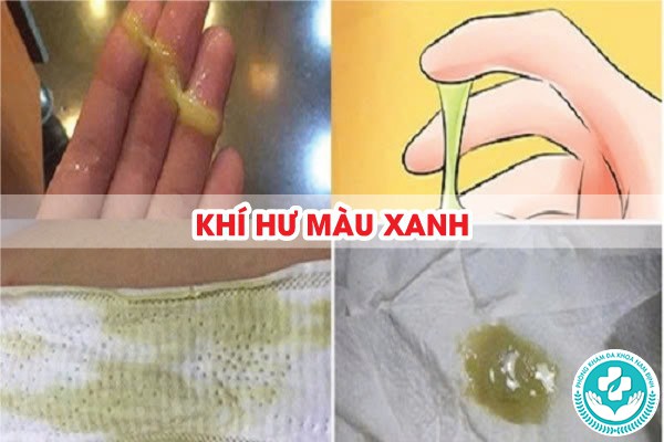 hình ảnh khí hư bất thường