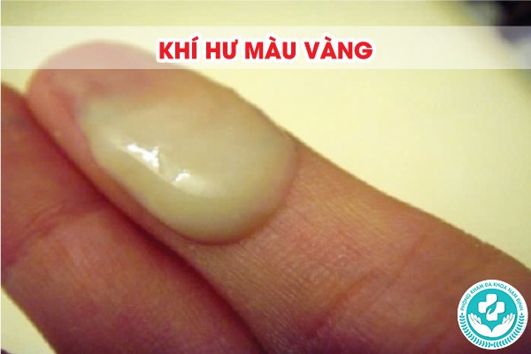 hình ảnh khí hư bất thường