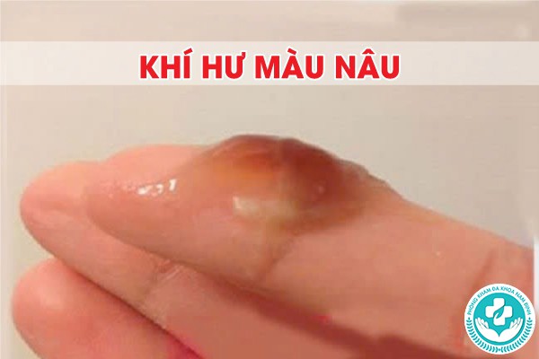 hình ảnh khí hư bất thường