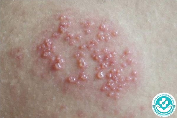 hình ảnh mụn rộp sinh dục nam
