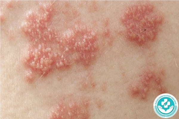 hình ảnh mụn rộp sinh dục nam