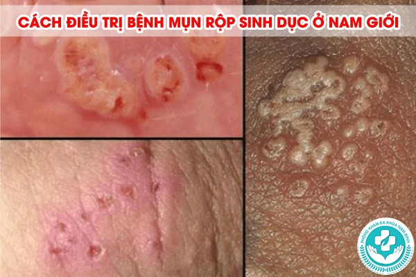 hình ảnh mụn rộp sinh dục nam