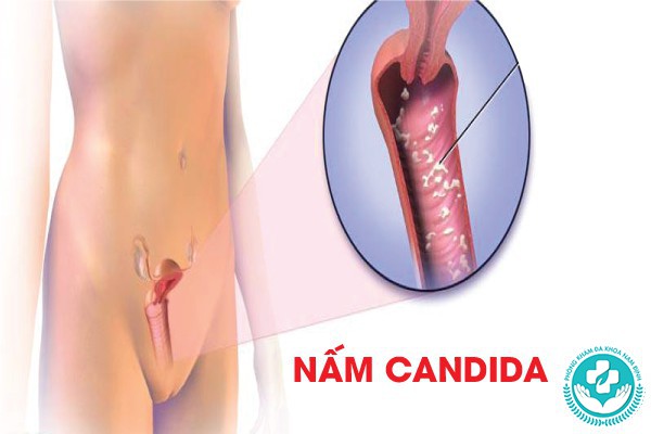 hình ảnh nấm âm đạo
