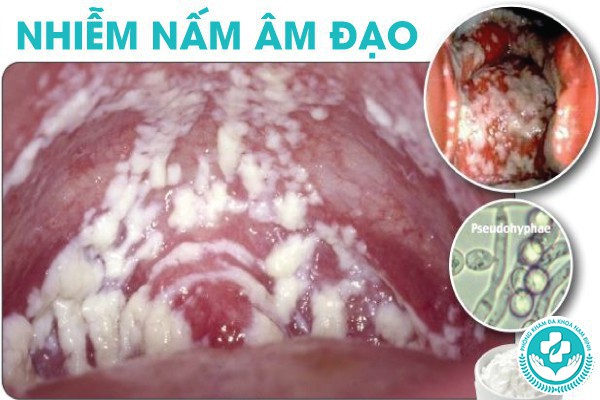 hình ảnh nấm âm đạo