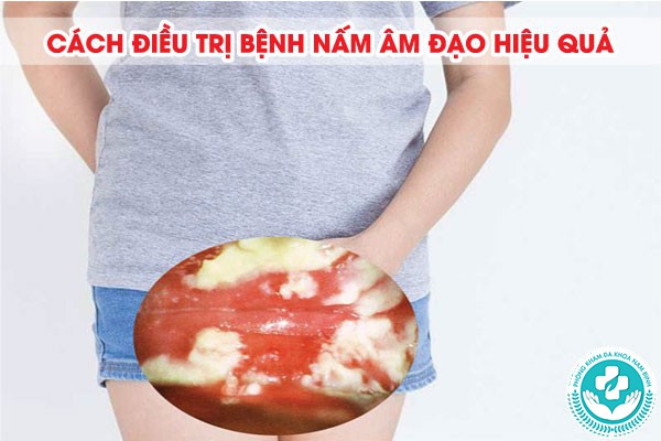 hình ảnh nấm âm đạo