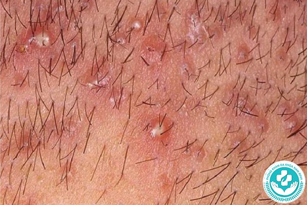 hình ảnh nổi mụn nhọt ở vùng kín nữ