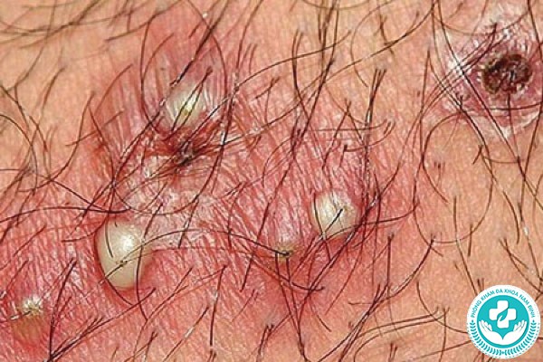 hình ảnh nổi mụn nhọt ở vùng kín nữ