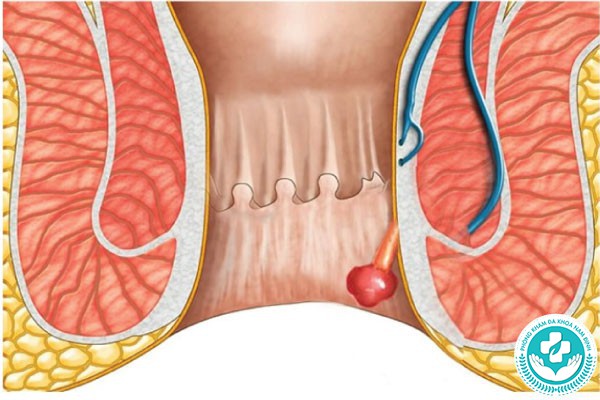 hình ảnh polyp hậu môn