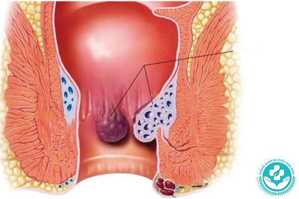 hình ảnh polyp hậu môn