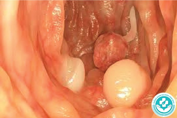 hình ảnh polyp hậu môn