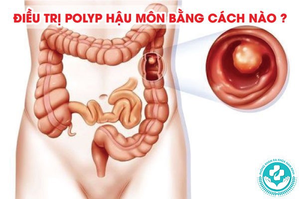 hình ảnh polyp hậu môn
