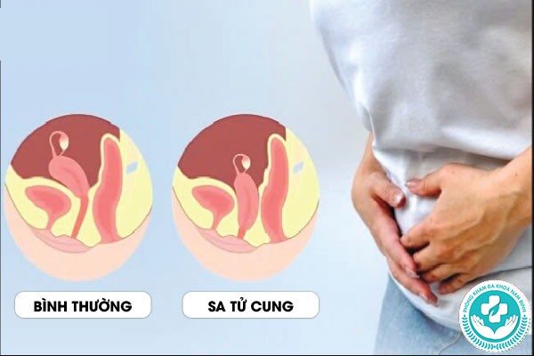 hình ảnh sa tử cung độ 1