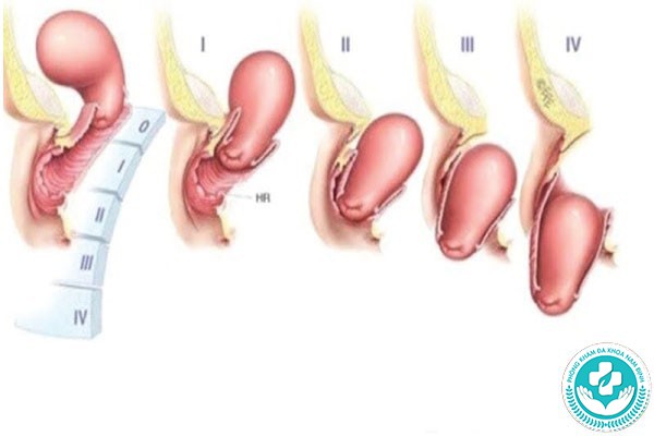 hình ảnh sa tử cung độ 1